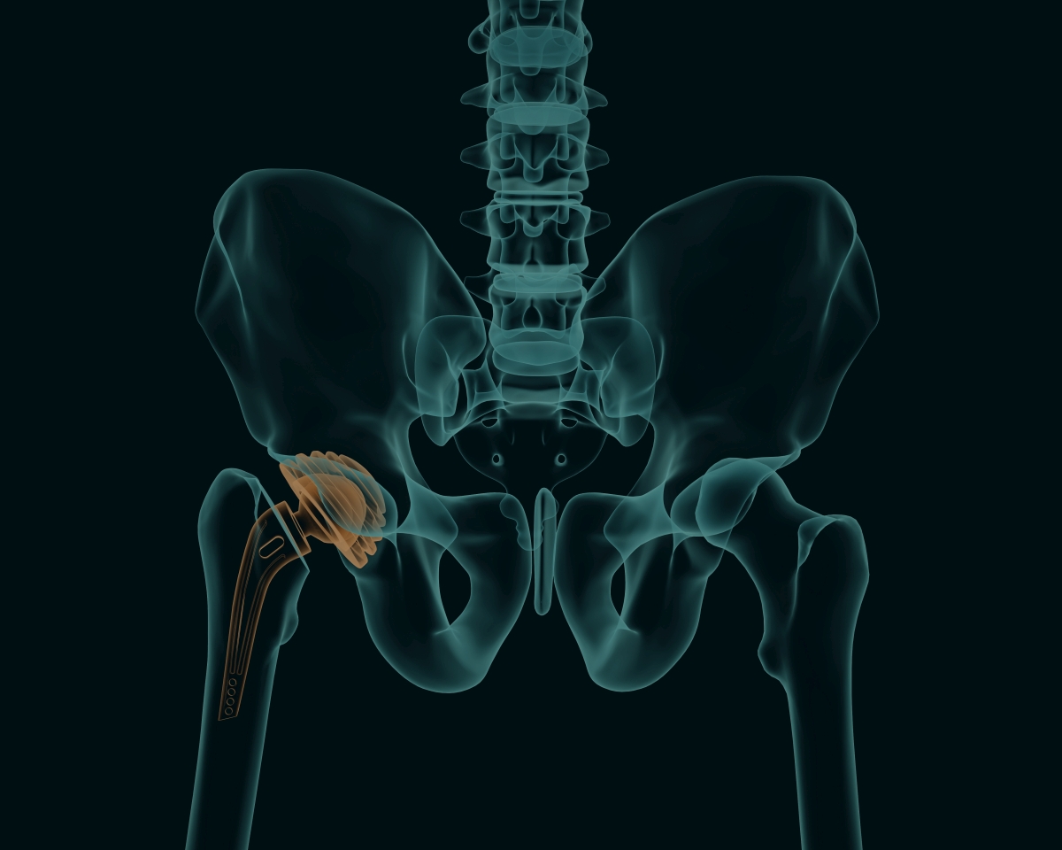 Hip Replacement Complications and Risks Morris Law Firm